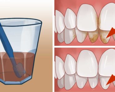 Here’s the easy home remedy for getting rid of unsightly tartar stains from your teeth