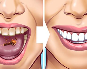 10 Ways to Remove Tartar Stains From Your Teeth